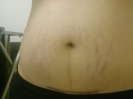 Linea Nigra When Not Pregnant