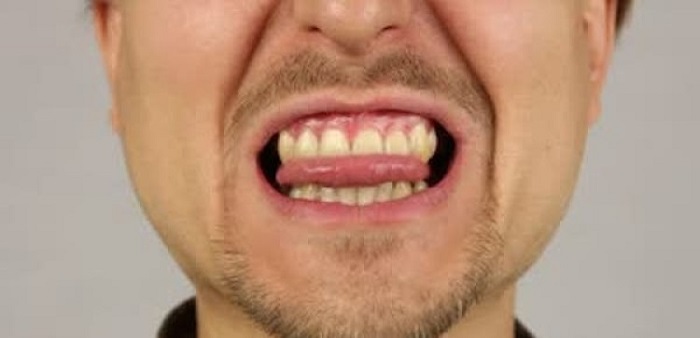 Image result for tongue bite