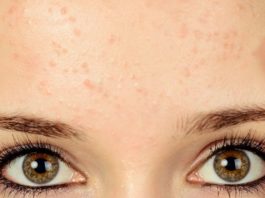 Infected Pore on Face, Nose and Leg – Causes and Treatment
