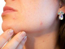 Does Milk Cause Acne?