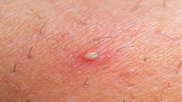 Ingrown Hair Cyst - Causes, Symptoms and Removal Treatment