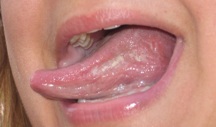 Red Spots On Roof Of Mouth Causes And Treatment 