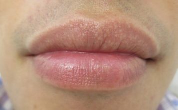 Fordyce Spots on Lips and Shaft – Causes and Treatment