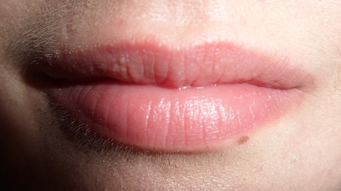Bumps on lips little Small White
