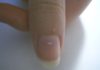 White Spots on Fingernails and Toenails – Causes and Treatment